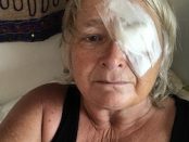 Cataract Surgery Playa del Carmen
